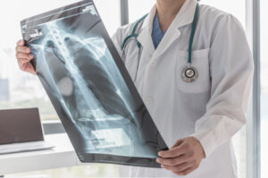What Are the Common Types of Chest Injuries Caused by Accidents and Other Trauma?